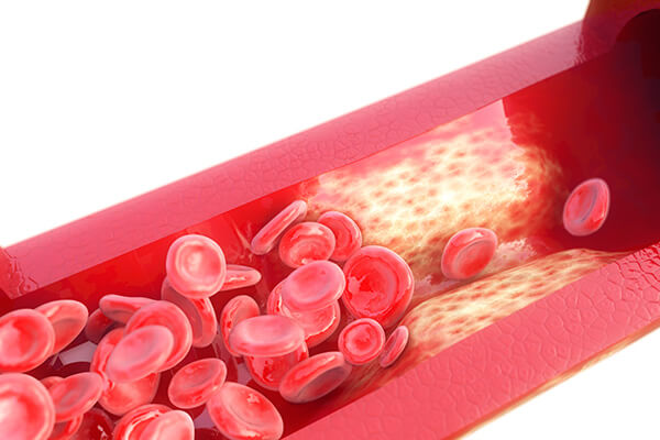 فشار خون بالا، قاتل خاموش